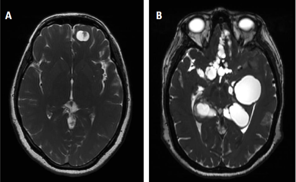 Figure 1. Radiological aspect of Neurocysticercosis caused by parenchymal 