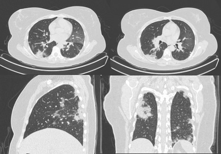 Tomografía de tórax simple ventana para pulmón