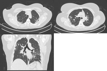 Tomografía de tórax simple ventana para pulmón