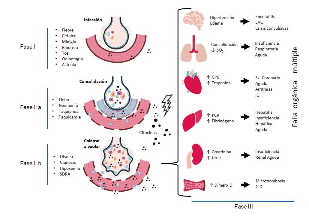 Fisiopatología de la enfermedad COVID-19 y sus manifestaciones clínicas pulmonares y sistémicas