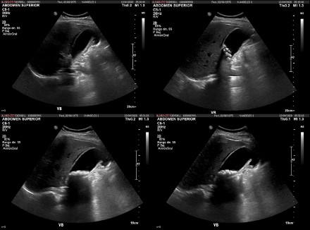 Ultrasonido de abdomen en escala de grises